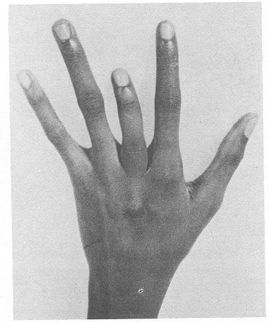 Shortened finger of African Adult male with sickle cell anemia, often the shortened finger is associated with obanje; Edelstein, 1986: p 72